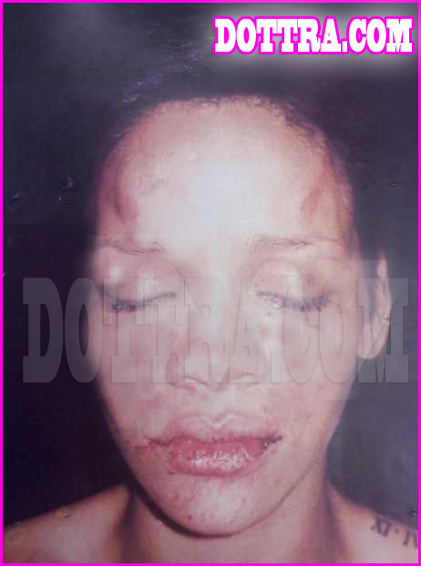 rihannas-buised-face-pictures2